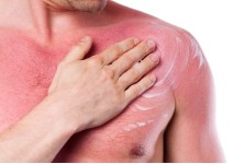 ΕΓΚΑΥΜΑΤΑ ΗΛΙΟΥ